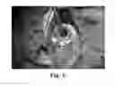 Fig. 03 - Method of implantation of left ventricular mechanical assist device HeartMate III