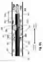 Fig. 22 - Ballooned ventilation tube cleaning device