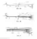 Fig. 04 - Balloon dilation catheter for use in sinus passageways