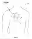 Fig. 02 - Delivery device for delivery of implantable or insertable medical devices