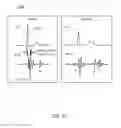 Fig. 28 - Cardiac pacing sensing and control