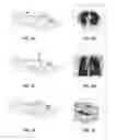 Fig. 03 - System and method for lung denervation