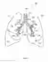 Fig. 04 - System and method for lung denervation