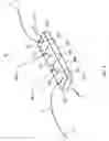 Fig. 02 - Knotless suture anchor construct