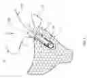 Fig. 04 - Knotless suture anchor construct