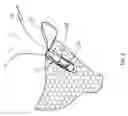 Fig. 06 - Knotless suture anchor construct