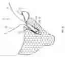 Fig. 07 - Knotless suture anchor construct