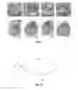 Fig. 02 - Needle instrument for eye-bag relocating operation