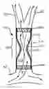 Fig. 01 - IMPLANTABLE DAMPING DEVICES FOR TREATING DEMENTIA AND ASSOCIATED SYSTEMS AND METHODS OF USE
