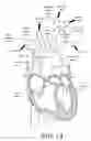 Fig. 02 - IMPLANTABLE DAMPING DEVICES FOR TREATING DEMENTIA AND ASSOCIATED SYSTEMS AND METHODS OF USE