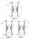 Fig. 08 - IMPLANTABLE DAMPING DEVICES FOR TREATING DEMENTIA AND ASSOCIATED SYSTEMS AND METHODS OF USE