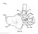 Fig. 17 - Wearable blood flow occlusion device