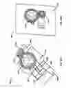 Fig. 26 - Wearable blood flow occlusion device