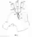 Fig. 06 - ROBOTICALLY SUPPORTED LAPAROSCOPIC ACCESS TOOLS