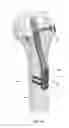 Fig. 43 - METHOD AND APPARATUS FOR TREATING A BONE FRACTURE