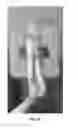 Fig. 49 - METHOD AND APPARATUS FOR TREATING A BONE FRACTURE