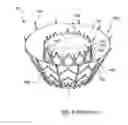 Fig. 02 - Valve delivery system having an integral displacement component for managing chordae tendineae in situ and methods of use thereof