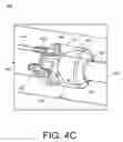 Fig. 07 - Inflatable penile prosthesis with valves for increasing flow efficiency