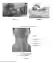 Fig. 02 - Device to Provide Optimal Positioning for Endotracheal Intubation or Cricothyroidotomy in the Emergency Department, in the Operating Room, and by First Responders on the Scene of Emergency Situations