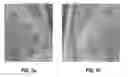 Fig. 08 - Liposomal statin formulation