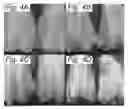 Fig. 06 - POLYMERIC PATCH SCAFFOLDS FOR ARTICULAR CARTILAGE REGENERATION