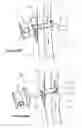 Fig. 35 - Surgical system and method of use