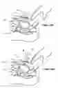 Fig. 44 - Surgical system and method of use
