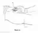 Fig. 45 - Surgical system and method of use
