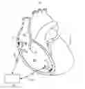 Fig. 01 - Pacing mode switching and rate response limit in a ventricular pacemaker