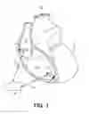 Fig. 02 - Pacing mode switching and rate response limit in a ventricular pacemaker