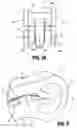 Fig. 04 - Ligation clip with latching and retention features