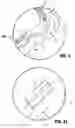 Fig. 05 - Ligation clip with latching and retention features