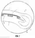 Fig. 07 - Ligation clip with latching and retention features