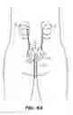Fig. 08 - SYSTEM AND METHOD FOR ENDOLUMINAL AND TRANSLUMENAL THERAPY