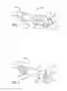 Fig. 02 - Differential compression bone screw