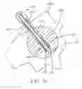 Fig. 07 - Microwave tissue ablation probe with non-metallic introducer set