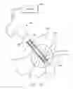 Fig. 09 - Microwave tissue ablation probe with non-metallic introducer set