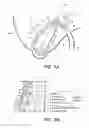 Fig. 02 - DEVICES AND METHODS TO TREAT GALLSTONE DISEASE