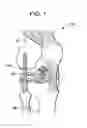 Fig. 02 - Mechanical fuse for surgical implants and related methods