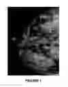 Fig. 02 - Methods of reducing mammographic breast density and/or breast cancer risk