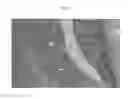 Fig. 08 - Methods and compositions to facilitate repair of avascular tissue