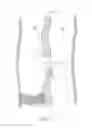 Fig. 08 - Methods for placing a stent-graft to cover collateral vessels in lower extremity vasculature