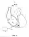 Fig. 02 - Rate smoothing to enhance atrial synchronous pacing in a ventricular pacemaker