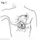 Fig. 02 - System for electrical therapeutic stimulation-based treatment of Brugada syndrome