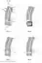 Fig. 03 - Laminated vehicle-side window with a leadthrough for fastening a clamping element