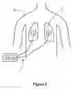 Fig. 03 - Stethoscope apparatus and a method of processing breathing sounds produced by a subject