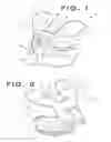 Fig. 02 - PATIENT-MATCHED TOTAL KNEE ARTHROSCOPY