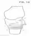 Fig. 07 - PATIENT-MATCHED TOTAL KNEE ARTHROSCOPY