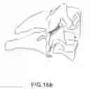 Fig. 131 - Vertebral joint implants and delivery tools