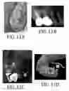 Fig. 09 - GUIDED ENDODONTIC MICRO-SURGERY (EMS) WITH TREPHINE BURS